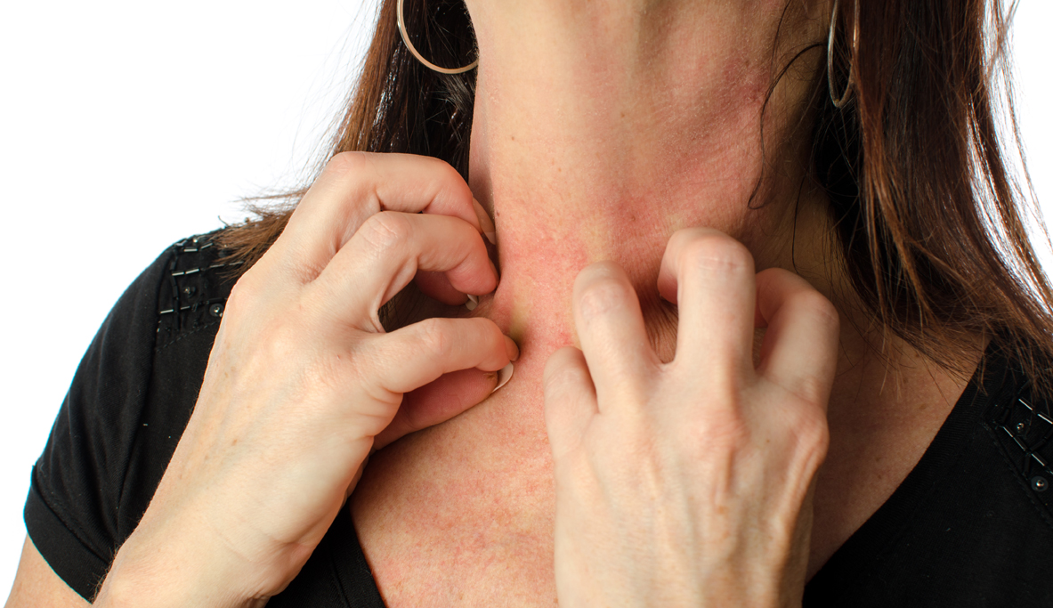 woman-scratching-her-neck-in-Eczema-condition